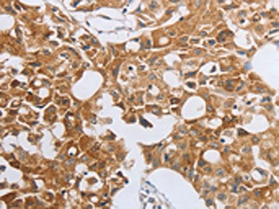 The image on the left is immunohistochemistry of paraffin-embedded Human lung cancer tissue using the antibody Antibody) at dilution 1/40, on the right is treated with fusion protein. (Original magnification: ×200)Rabbit anti-Human MUC20 Polyclonal Antibody