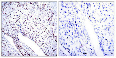 Immunohistochemical analysis of paraffin-embedded human breast carcinoma tissue using STAT3(Ab-705) antibody.Rabbit anti-Human STAT3 Polyclonal Antibody