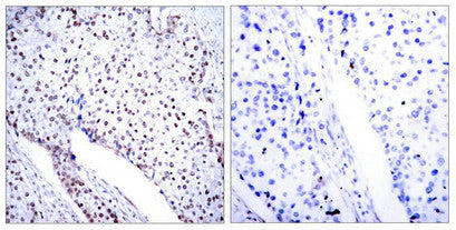 Immunohistochemical analysis of paraffin-embedded human breast carcinoma tissue using STAT3(Ab-705) antibody.Rabbit anti-Human STAT3 Polyclonal Antibody