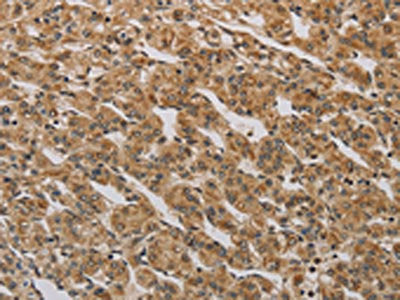 The image on the left is immunohistochemistry of paraffin-embedded Human prostate cancer tissue using BRAF Antibody(BRAF Antibody) at dilution 1/30, on the right is treated with synthetic peptide. (Original magnification: ×200)