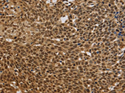 The image on the left is immunohistochemistry of paraffin-embedded Human cervical cancer tissue using the antibody Antibody) at dilution 1/30, on the right is treated with synthetic peptide. (Original magnification: ×200)