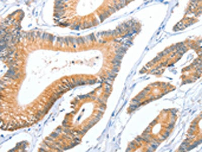 The image on the left is immunohistochemistry of paraffin-embedded Human colon cancer tissue using ACY3 Antibody(ACY3 Antibody) at dilution 1/35, on the right is treated with fusion protein. (Original magnification: ×200)Rabbit anti-Human ACY3 Polyclonal Antibody