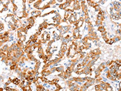 The image on the left is immunohistochemistry of paraffin-embedded Human thyroid cancer tissue using the antibody Antibody) at dilution 1/35, on the right is treated with fusion protein. (Original magnification: ×200)