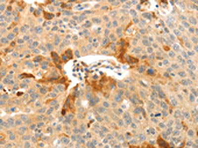 The image on the left is immunohistochemistry of paraffin-embedded Human ovarian cancer tissue using CFHR1 Antibody(CFHR1 Antibody) at dilution 1/30, on the right is treated with fusion protein. (Original magnification: ×200)Rabbit anti-Human CFHR1 Polyclonal Antibody