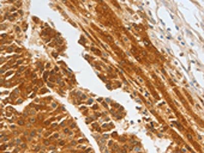 The image on the left is immunohistochemistry of paraffin-embedded Human liver cancer tissue using the antibody Antibody) at dilution 1/30, on the right is treated with fusion protein. (Original magnification: ×200)Rabbit anti-Human CFHR1 Polyclonal Antibody
