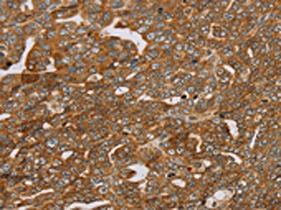 The image on the left is immunohistochemistry of paraffin-embedded Human cervical cancer tissue using PLEKHG6 Antibody(PLEKHG6 Antibody) at dilution 1/45, on the right is treated with fusion protein. (Original magnification: ×200)Rabbit anti-Human PLEKHG6 Polyclonal Antibody