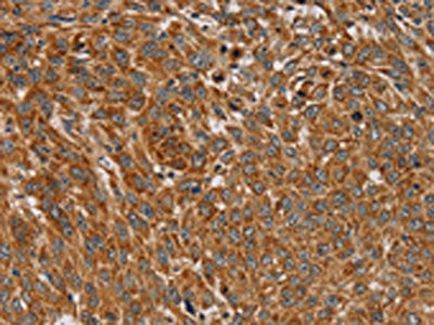 The image on the left is immunohistochemistry of paraffin-embedded Human lung cancer tissue using the antibody Antibody) at dilution 1/45, on the right is treated with fusion protein. (Original magnification: ×200)Rabbit anti-Human PLEKHG6 Polyclonal Antibody