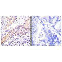 Immunohistochemistry analysis of paraffin-embedded human lung carcinoma tissue using Topoisomerase II β antibody.Rabbit anti-Human TOP2B Polyclonal Antibody