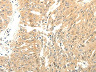 The image on the left is immunohistochemistry of paraffin-embedded Human ovarian cancer tissue using SOX2 Antibody(SOX2 Antibody) at dilution 1/15, on the right is treated with fusion protein. (Original magnification: ×200)Rabbit anti-Human SOX2 Polyclonal Antibody