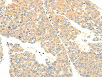The image on the left is immunohistochemistry of paraffin-embedded Human liver cancer tissue using the antibody Antibody) at dilution 1/15, on the right is treated with fusion protein. (Original magnification: ×200)Rabbit anti-Human SOX2 Polyclonal Antibody