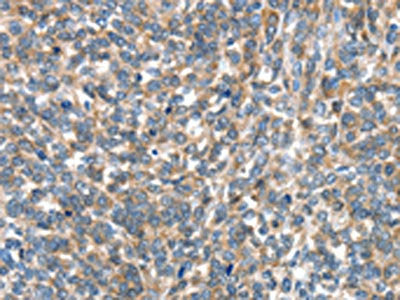 The image on the left is immunohistochemistry of paraffin-embedded Human ovarian cancer tissue using EIF4EBP1 Antibody(EIF4EBP1 Antibody) at dilution 1/30, on the right is treated with fusion protein. (Original magnification: ×200)Rabbit anti-Human EIF4EBP1 Polyclonal Antibody