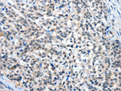 The image on the left is immunohistochemistry of paraffin-embedded Human esophagus cancer tissue using the antibody Antibody) at dilution 1/30, on the right is treated with fusion protein. (Original magnification: ×200)Rabbit anti-Human EIF4EBP1 Polyclonal Antibody