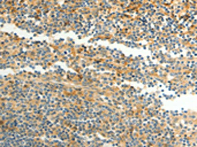 The image on the left is immunohistochemistry of paraffin-embedded Human tonsil tissue using CFHR1 Antibody(CFHR1 Antibody) at dilution 1/40, on the right is treated with fusion protein. (Original magnification: ×200)Rabbit anti-Human CFHR1 Polyclonal Antibody