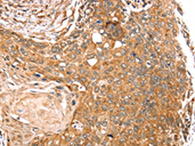 The image on the left is immunohistochemistry of paraffin-embedded Human esophagus cancer tissue using SEMA7A Antibody(SEMA7A Antibody) at dilution 1/20, on the right is treated with synthetic peptide. (Original magnification: ×200)Rabbit anti-Human SEMA7A Polyclonal Antibody