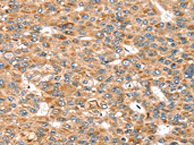 The image on the left is immunohistochemistry of paraffin-embedded Human liver cancer tissue using the antibody Antibody) at dilution 1/20, on the right is treated with synthetic peptide. (Original magnification: ×200)Rabbit anti-Human SEMA7A Polyclonal Antibody