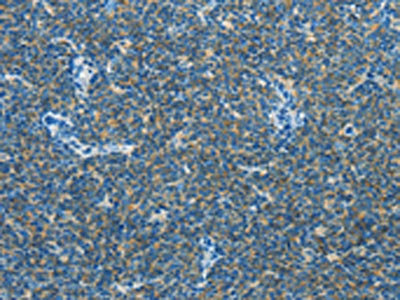 The image on the left is immunohistochemistry of paraffin-embedded Human lymphoma tissue using CAV3 Antibody(CAV3 Antibody) at dilution 1/30, on the right is treated with synthetic peptide. (Original magnification: ×200)