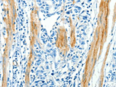 The image on the left is immunohistochemistry of paraffin-embedded Human gastic cancer tissue using the antibody Antibody) at dilution 1/30, on the right is treated with synthetic peptide. (Original magnification: ×200)