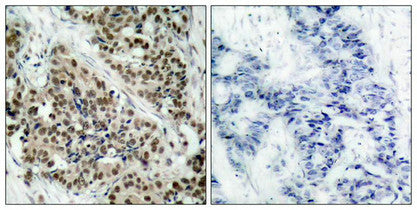 Immunohistochemical analysis of paraffin-embedded human breast carcinoma tissue using FKHR (Phospho-Ser256) Antibody (left) or the same antibody preincubated with blocking peptide (right).Rabbit anti-Human FOXO1 Polyclonal Antibody