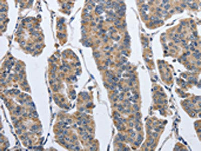 The image on the left is immunohistochemistry of paraffin-embedded Human breast cancer tissue using IPO7 Antibody(IPO7 Antibody) at dilution 1/40, on the right is treated with synthetic peptide. (Original magnification: ×200)