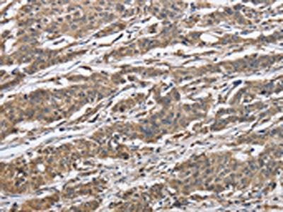The image on the left is immunohistochemistry of paraffin-embedded Human gastic cancer tissue using the antibody Antibody) at dilution 1/40, on the right is treated with synthetic peptide. (Original magnification: ×200)