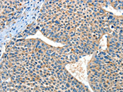The image on the left is immunohistochemistry of paraffin-embedded Human liver cancer tissue using ADRA1A Antibody(ADRA1A Antibody) at dilution 1/60, on the right is treated with synthetic peptide. (Original magnification: ×200)Rabbit anti-Human ADRA1A Polyclonal Antibody