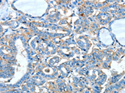 The image on the left is immunohistochemistry of paraffin-embedded Human thyroid cancer tissue using the antibody Antibody) at dilution 1/60, on the right is treated with synthetic peptide. (Original magnification: ×200)