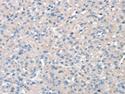 The image on the left is immunohistochemistry of paraffin-embedded Human liver cancer tissue using SNX3 Antibody(SNX3 Antibody) at dilution 1/30, on the right is treated with synthetic peptide. (Original magnification: ×200)Rabbit anti-Human SNX3 Polyclonal Antibody