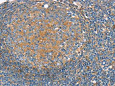 The image on the left is immunohistochemistry of paraffin-embedded Human tonsil tissue using the antibody Antibody) at dilution 1/30, on the right is treated with synthetic peptide. (Original magnification: ×200)Rabbit anti-Human SNX3 Polyclonal Antibody