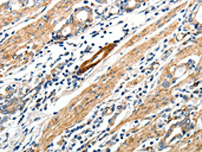 The image on the left is immunohistochemistry of paraffin-embedded Human gastric cancer tissue using STEAP4 Antibody(STEAP4 Antibody) at dilution 1/25, on the right is treated with synthetic peptide. (Original magnification: ×200)Rabbit anti-Human STEAP4 Polyclonal Antibody