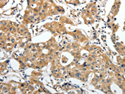 The image on the left is immunohistochemistry of paraffin-embedded Human lung cancer tissue using the antibody Antibody) at dilution 1/25, on the right is treated with synthetic peptide. (Original magnification: ×200)Rabbit anti-Human STEAP4 Polyclonal Antibody