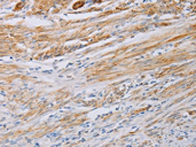 The image on the left is immunohistochemistry of paraffin-embedded Human cervical cancer tissue using MYL6 Antibody(MYL6 Antibody) at dilution 1/40, on the right is treated with fusion protein. (Original magnification: ×200)Rabbit anti-Human MYL6 Polyclonal Antibody