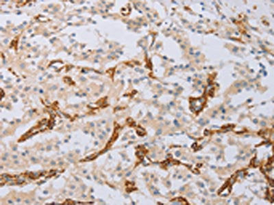 The image on the left is immunohistochemistry of paraffin-embedded Human thyroid cancer tissue using the antibody Antibody) at dilution 1/40, on the right is treated with fusion protein. (Original magnification: ×200)Rabbit anti-Human MYL6 Polyclonal Antibody