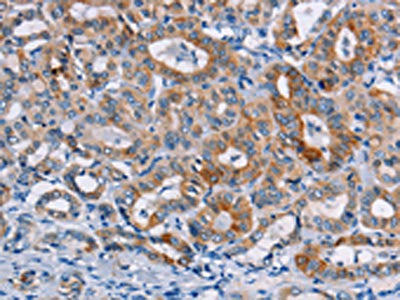 The image on the left is immunohistochemistry of paraffin-embedded Human thyroid cancer tissue using CASC3 Antibody(CASC3 Antibody) at dilution 1/20, on the right is treated with fusion protein. (Original magnification: ×200)