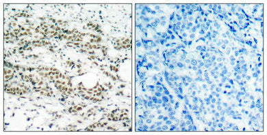 Immunohistochemical analysis of paraffin-embedded human breast carcinoma tissue using AFX(Phospho-Ser197) Antibody(left) or the same antibody preincubated with blocking peptide(right).Rabbit anti-Human FOXO4 Polyclonal Antibody