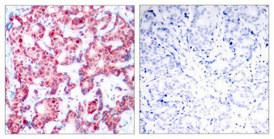 Immunohistochemical analysis of paraffin-embedded human breast carcinoma tissue using GATA1(Phospho-Ser142) Antibody(left) or the same antibody preincubated with blocking peptide(right).Rabbit anti-Human GATA1 Polyclonal Antibody