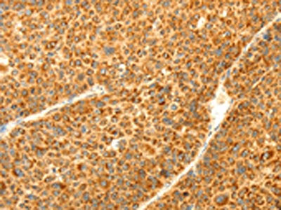 The image on the left is immunohistochemistry of paraffin-embedded Human liver cancer tissue using DIABLO Antibody(DIABLO Antibody) at dilution 1/70, on the right is treated with fusion protein. (Original magnification: ×200)Rabbit anti-Human DIABLO Polyclonal Antibody