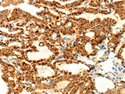 The image on the left is immunohistochemistry of paraffin-embedded Human thyroid cancer tissue using the antibody Antibody) at dilution 1/70, on the right is treated with fusion protein. (Original magnification: ×200)Rabbit anti-Human DIABLO Polyclonal Antibody