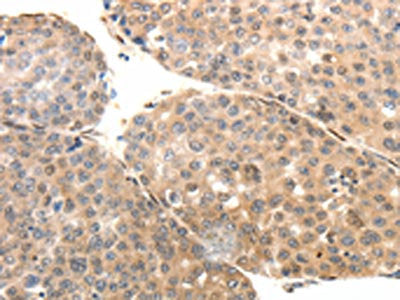 The image on the left is immunohistochemistry of paraffin-embedded Human liver cancer tissue using the antibody Antibody) at dilution 1/15, on the right is treated with fusion protein. (Original magnification: ×200)Rabbit anti-Human SYT7 Polyclonal Antibody