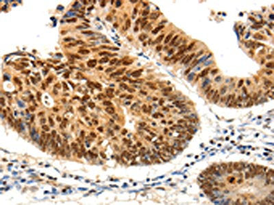 The image on the left is immunohistochemistry of paraffin-embedded Human colon cancer tissue using PDCD6 Antibody(PDCD6 Antibody) at dilution 1/25, on the right is treated with fusion protein. (Original magnification: ×200)Rabbit anti-Human PDCD6 Polyclonal Antibody