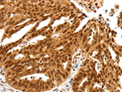 The image on the left is immunohistochemistry of paraffin-embedded Human ovarian cancer tissue using the antibody Antibody) at dilution 1/25, on the right is treated with fusion protein. (Original magnification: ×200)Rabbit anti-Human PDCD6 Polyclonal Antibody