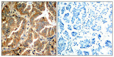 Immunohistochemical analysis of paraffin-embedded human lung carcinoma tissue using ADD1(Ab-726) Antibody(left) or the same antibody preincubated with blocking peptide(right).Rabbit anti-Human ADD1 Polyclonal Antibody