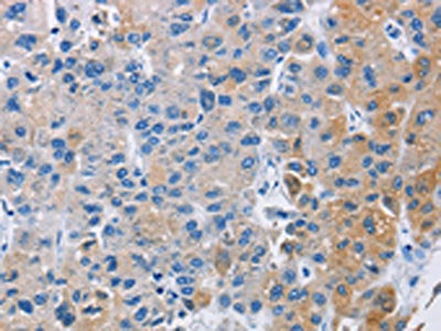 The image on the left is immunohistochemistry of paraffin-embedded Human liver cancer tissue using the antibody Antibody) at dilution 1/30, on the right is treated with fusion protein. (Original magnification: ×200)