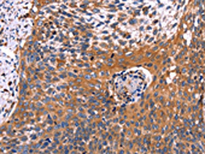 The image on the left is immunohistochemistry of paraffin-embedded Human cervical cancer tissue using the antibody Antibody) at dilution 1/60, on the right is treated with fusion protein. (Original magnification: ×200)Rabbit anti-Human RDX Polyclonal Antibody