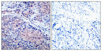 Immunohistochemical analysis of paraffin-embedded human breast carcinoma tissue using IkB-a(Ab-32/36) Antibody(left) or the same antibody preincubated with blocking peptide(right).Rabbit anti-Human NFKBIA Polyclonal Antibody