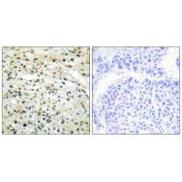 Immunohistochemistry analysis of paraffin-embedded human liver carcinoma tissue using DNMT3B antibody.Rabbit anti-Human DNMT3B Polyclonal Antibody
