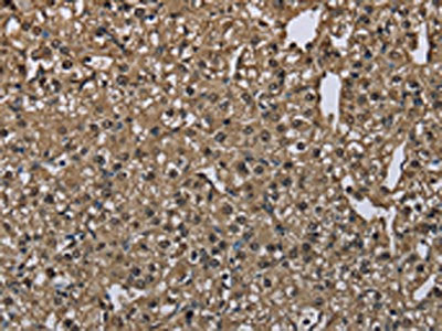 The image on the left is immunohistochemistry of paraffin-embedded Human prostate cancer tissue using GSTA3 Antibody(GSTA3 Antibody) at dilution 1/30, on the right is treated with fusion protein. (Original magnification: ×200)