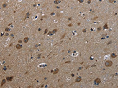 The image on the left is immunohistochemistry of paraffin-embedded Human brain tissue using the antibody Antibody) at dilution 1/30, on the right is treated with fusion protein. (Original magnification: ×200)