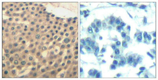 Immunohistochemical analysis of paraffin-embedded human lung carcinoma tissue using HDAC4/HDAC5/HDAC9(Ab-246/259/220) Antibody(left) or the same antibody preincubated with blocking peptide(right).Rabbit anti-Human HDAC4/HDAC5/HDAC9 Polyclonal Antibody