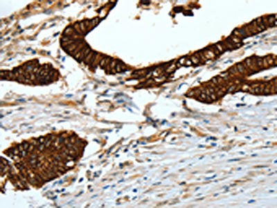 The image on the left is immunohistochemistry of paraffin-embedded Human colon cancer tissue using KRT18 Antibody(KRT18 Antibody) at dilution 1/50, on the right is treated with fusion protein. (Original magnification: X200)