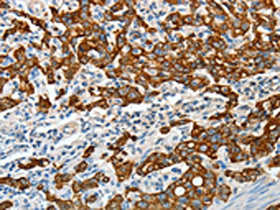 The image on the left is immunohistochemistry of paraffin-embedded Human gastric cancer tissue using the antibody Antibody) at dilution 1/50, on the right is treated with fusion protein. (Original magnification: X200)